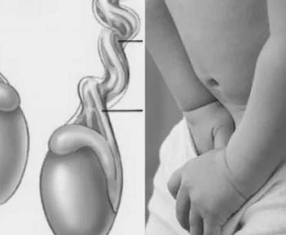 Cách nhận biết khối phồng ở vùng bẹn có thể là thoát vị bẹn